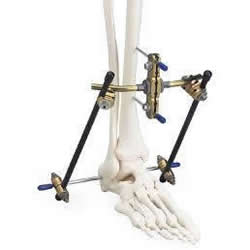 External Fixators