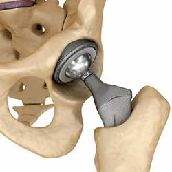 Hip replacement implant 2